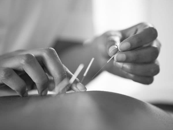 Acupuncture Therapy Session